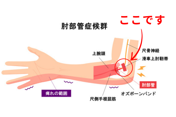 肘部管症候群