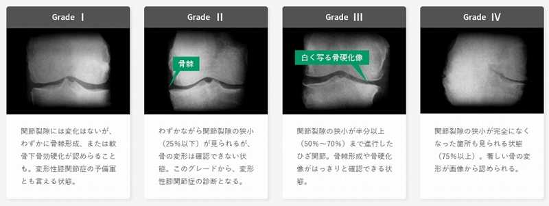 変形性膝関節症 画像