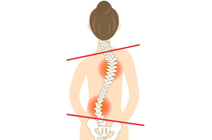 膝の痛み、変形性膝関節症