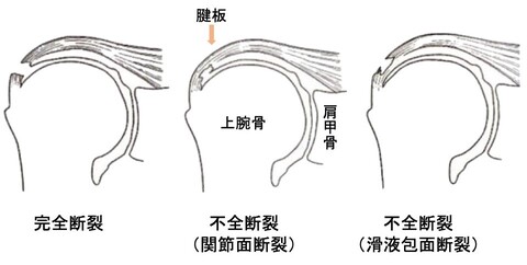 肩関節インピンジメント症候群