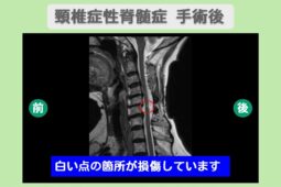 頚椎症性脊髄症