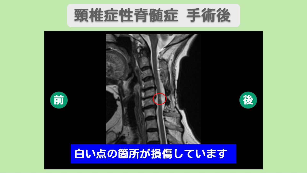 頚椎症性脊髄症