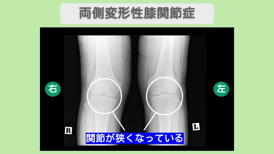 変形性膝関節症
