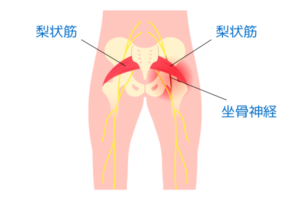 梨状筋症候群