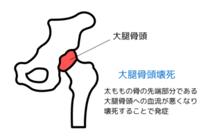 股関節の右だけ痛い