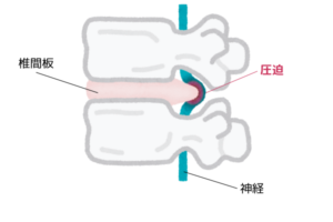 椎間板ヘルニア