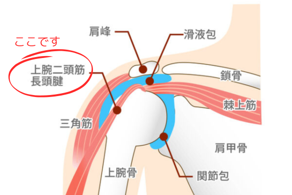 上腕二頭筋長頭腱炎
