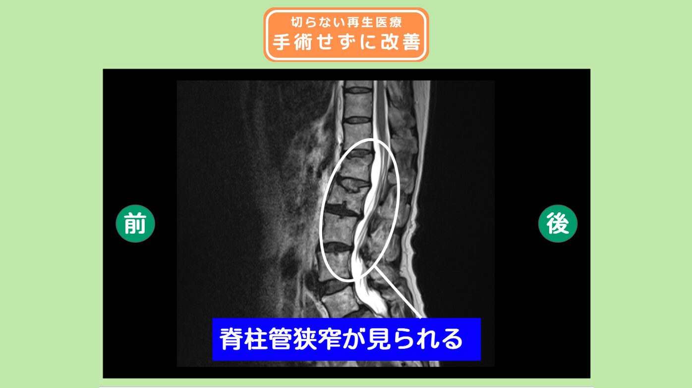 腰部脊柱管狭窄症