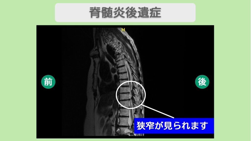 脊髄炎後遺症　幹細胞治療