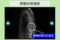 脊髄炎後遺症　幹細胞治療