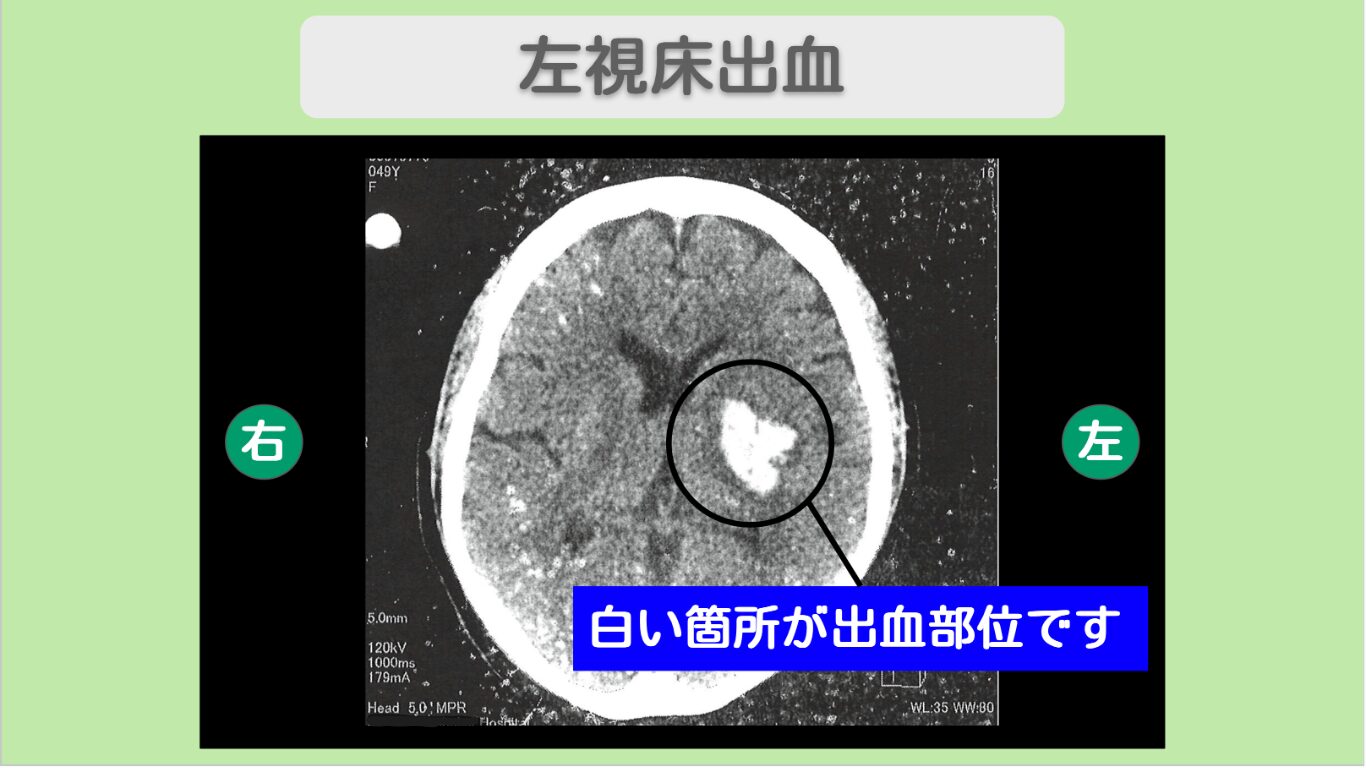 脳出血 幹細胞治療