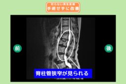 腰部脊柱管狭窄症