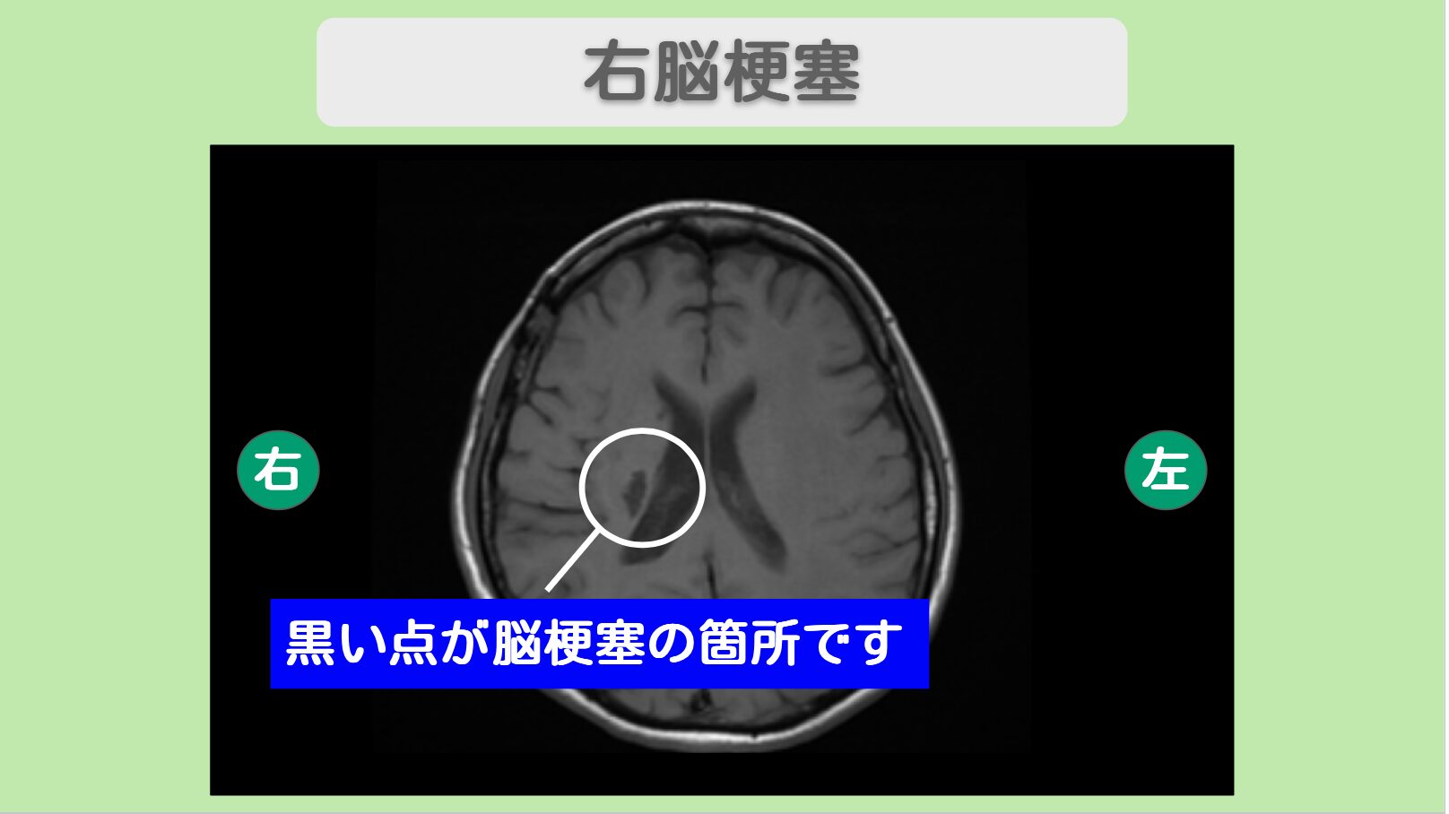 急性期脳梗塞 幹細胞治療