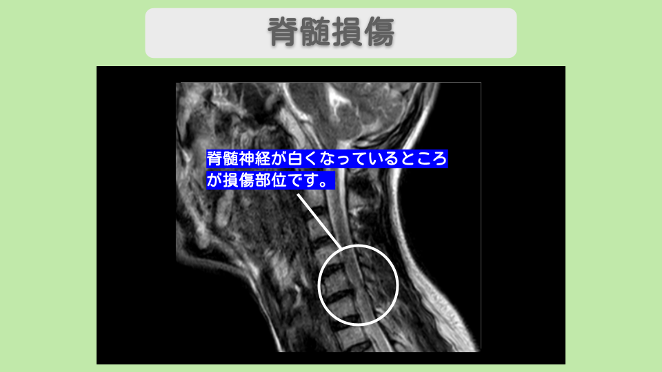 頸髄損傷　幹細胞治療