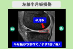 半月板損傷