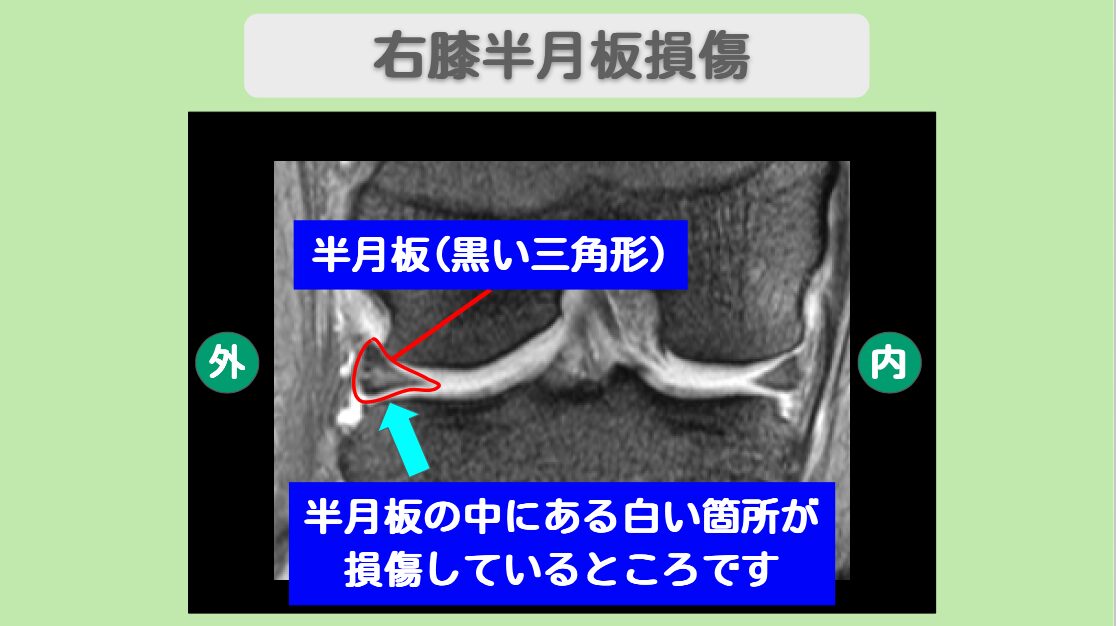 半月板損傷