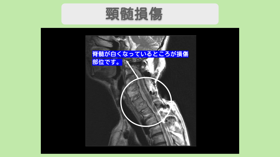 頚椎症性脊髄症 幹細胞治療