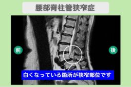 脊椎疾患への新たな光明：手術前に考えたい幹細胞治療の可能性 MRI検査で　脊髄の狭窄・損傷　を確認しました。