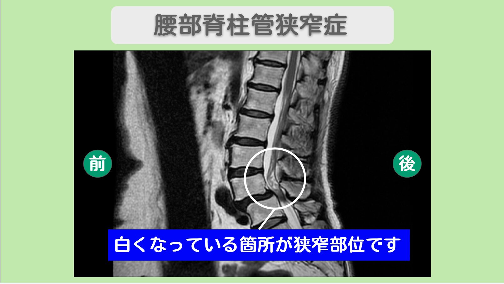 脊椎疾患への新たな光明：手術前に考えたい幹細胞治療の可能性 MRI検査で　脊髄の狭窄・損傷　を確認しました。