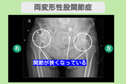 両変形性股関節症 幹細胞治療