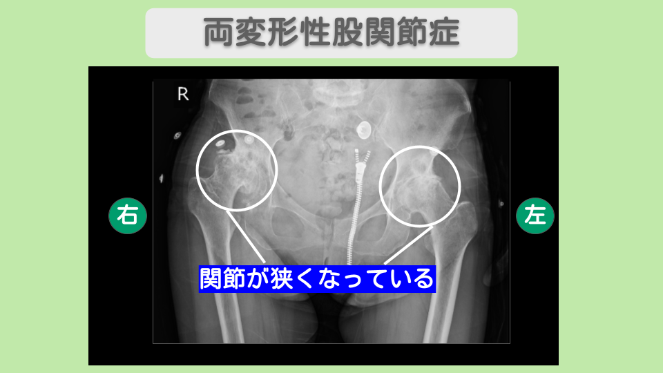 両変形性股関節症 幹細胞治療