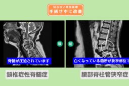 腰部脊柱管狭窄症、頚椎症性脊髄症