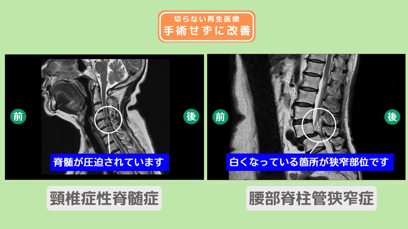 腰部脊柱管狭窄症、頚椎症性脊髄症