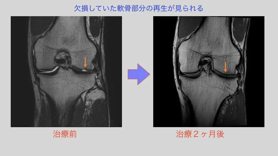 膝関節