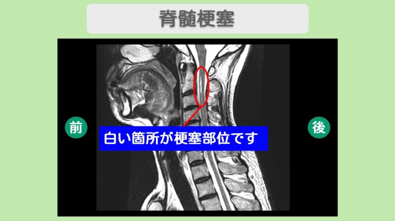 脊髄梗塞 幹細胞治療