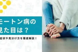 モートン病 見た目