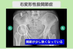 右変形性股関節症　幹細胞治療
