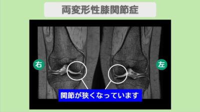 両変形性膝関節症 幹細胞治療