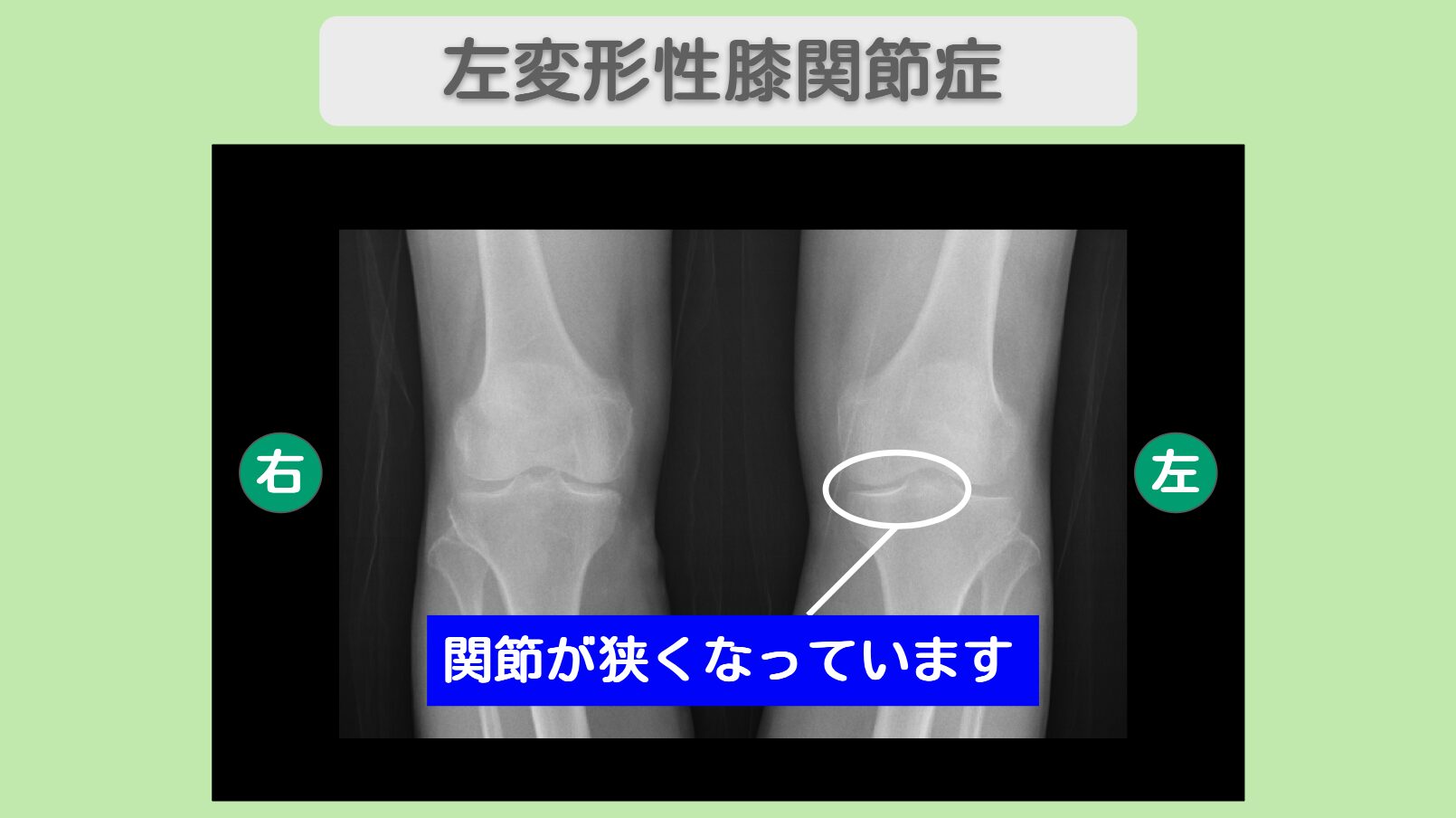 左変形性膝関節症　幹細胞治療