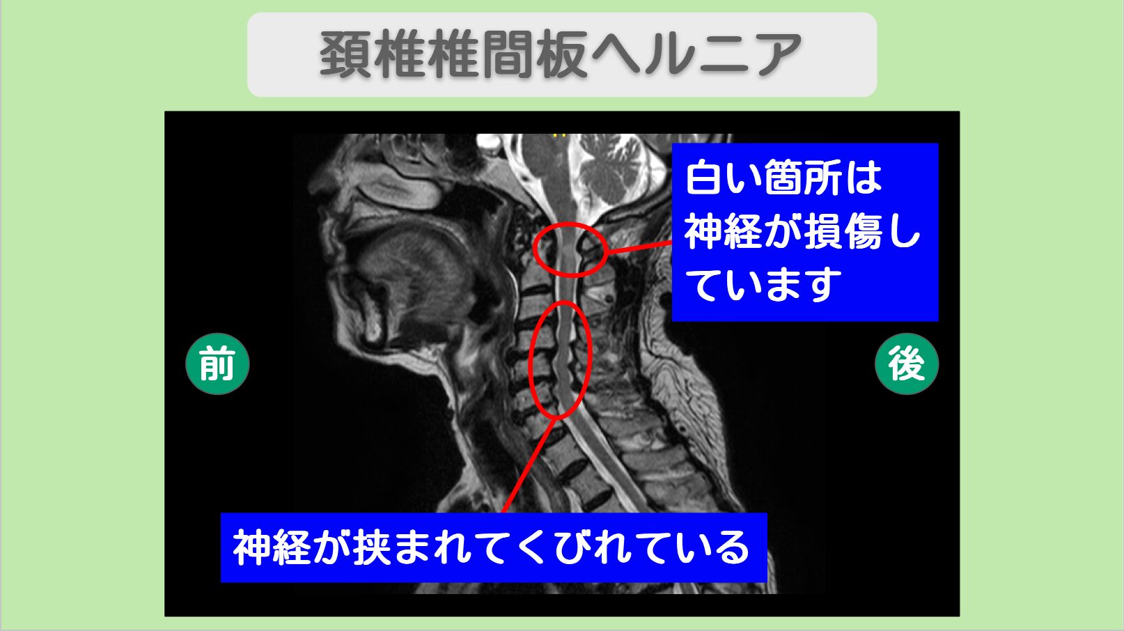頸椎椎間板ヘルニア　幹細胞治療