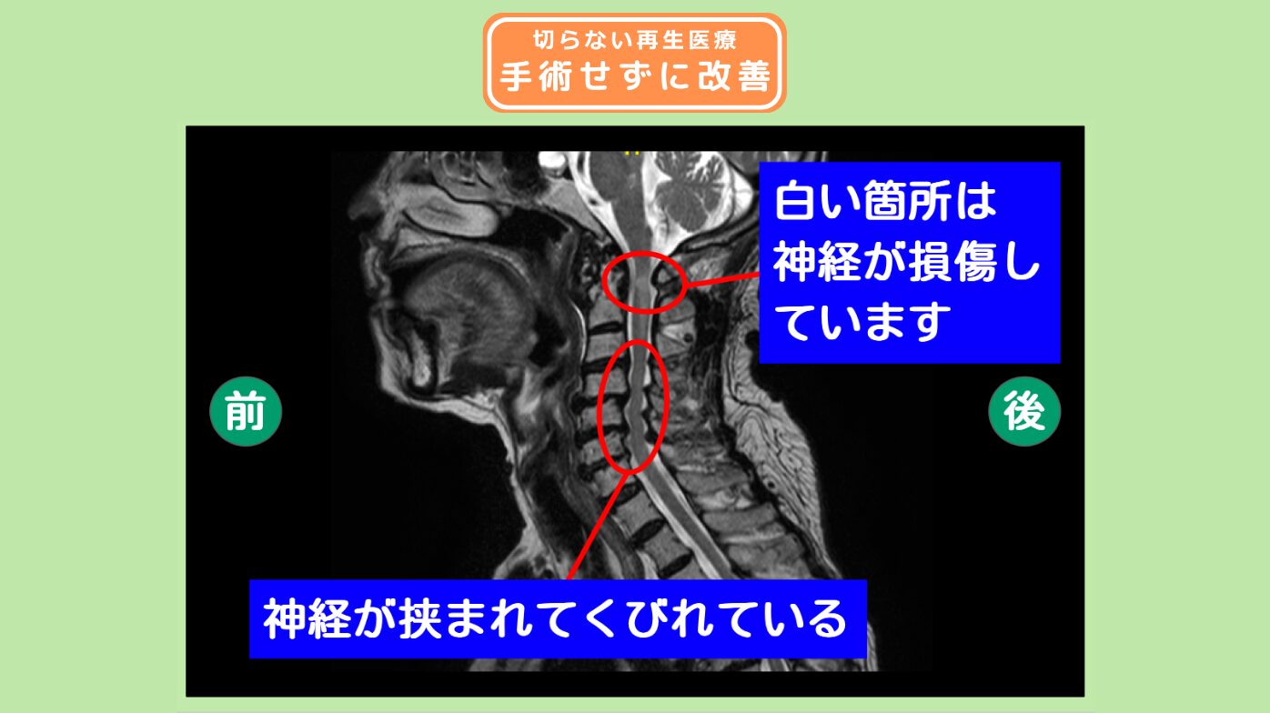 腰部脊柱管狭窄症、頚椎症性脊髄症