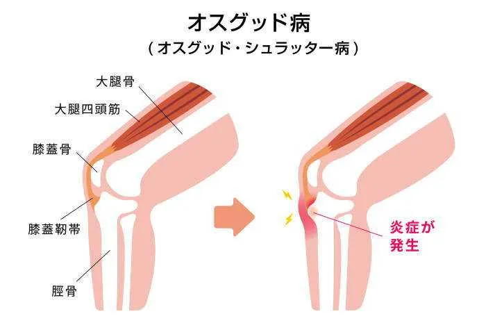 オスグッド病