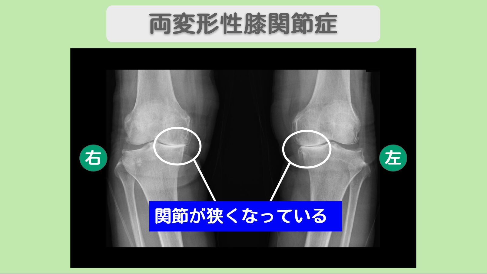 両変形性膝関節症　幹細胞治療