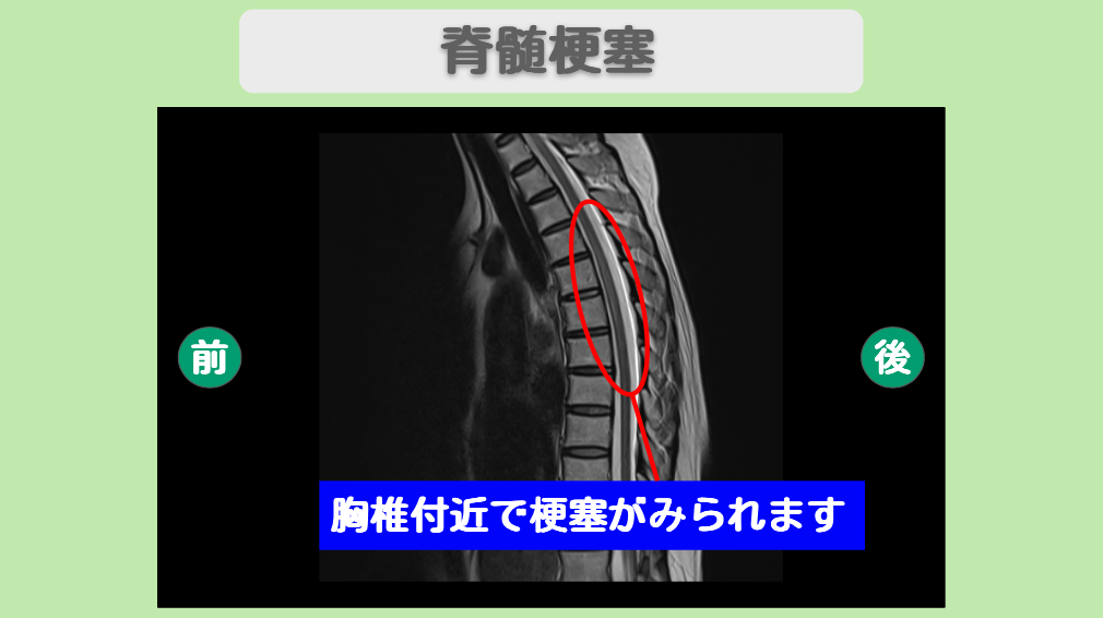 脊髄梗塞　幹細胞治療