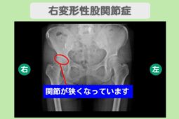 変形性股関節症