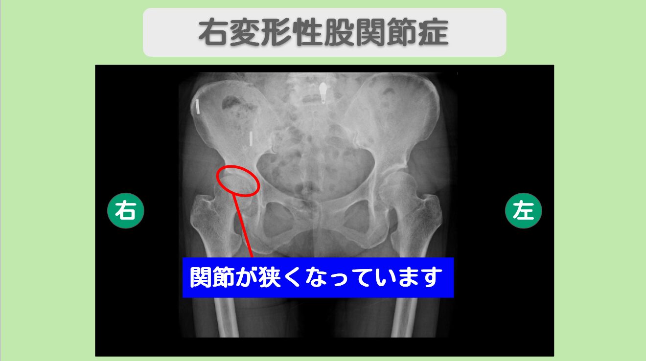 変形性股関節症
