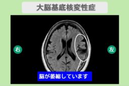 大脳基底核変性症　幹細胞治療