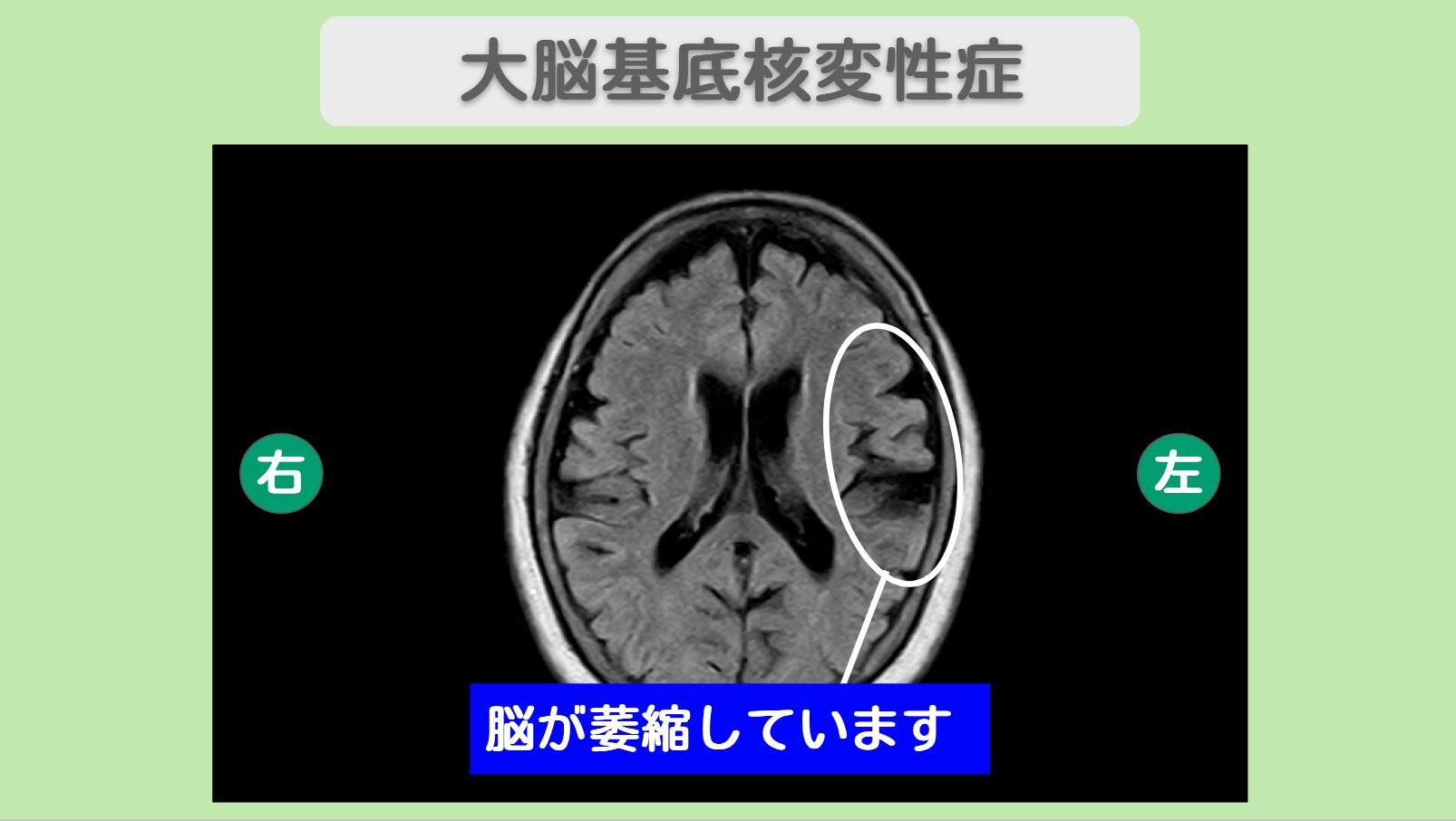 大脳基底核変性症 幹細胞治療
