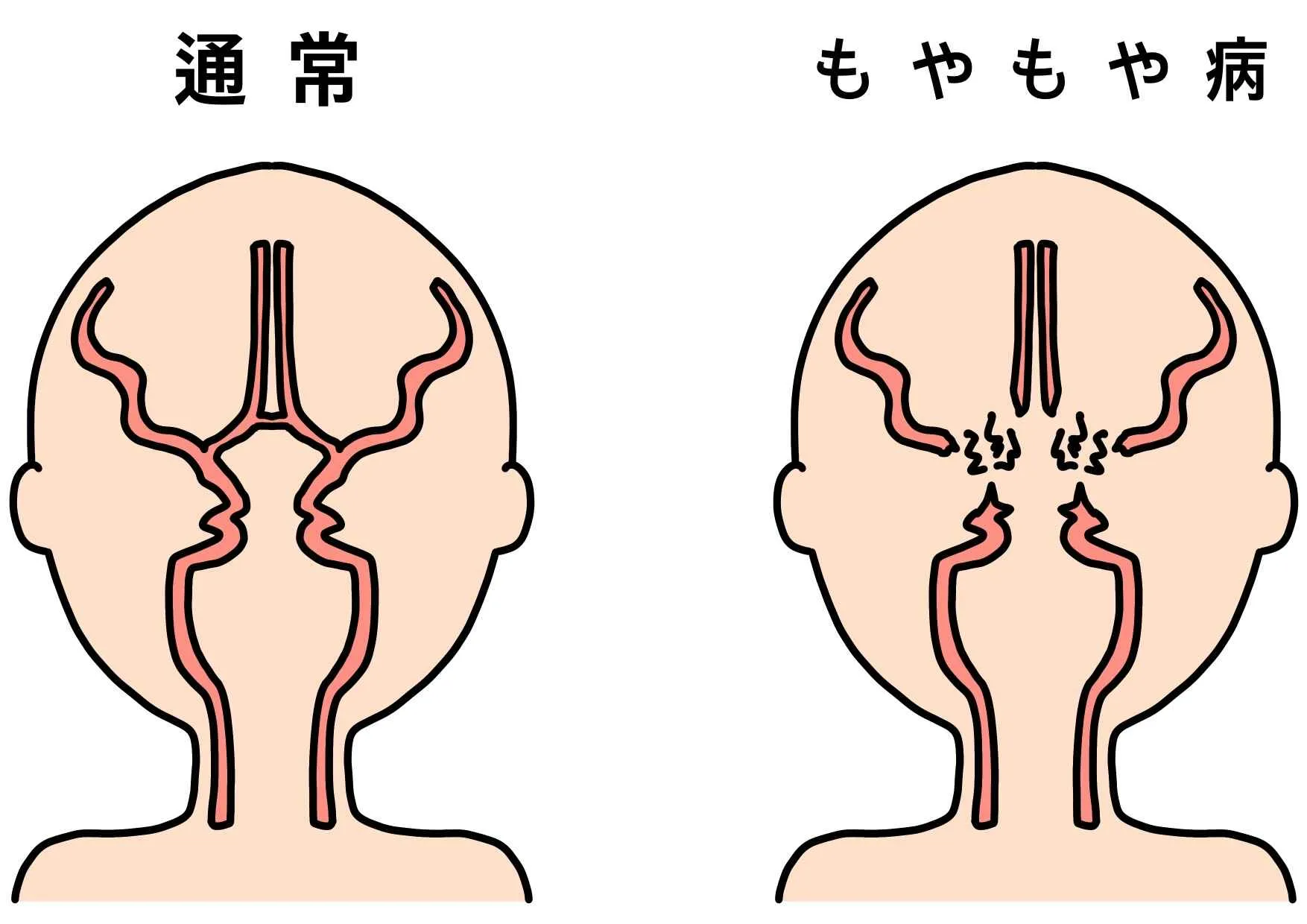 もやもや病の原因