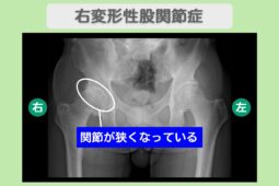 右変形性股関節症　幹細胞治療