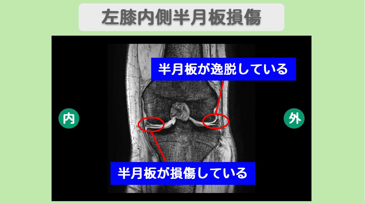 左膝半月板損傷　幹細胞治療