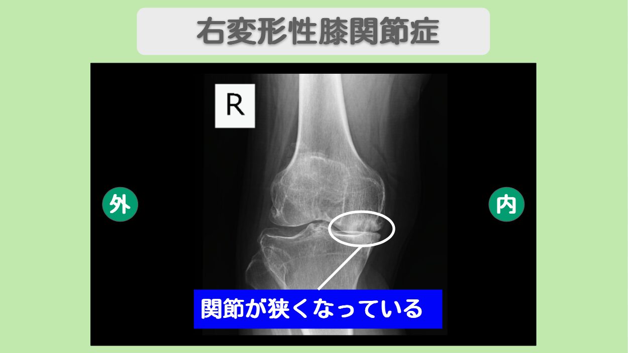 右変形性膝関節症　幹細胞治療