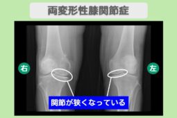 両変形性膝関節症　幹細胞治療