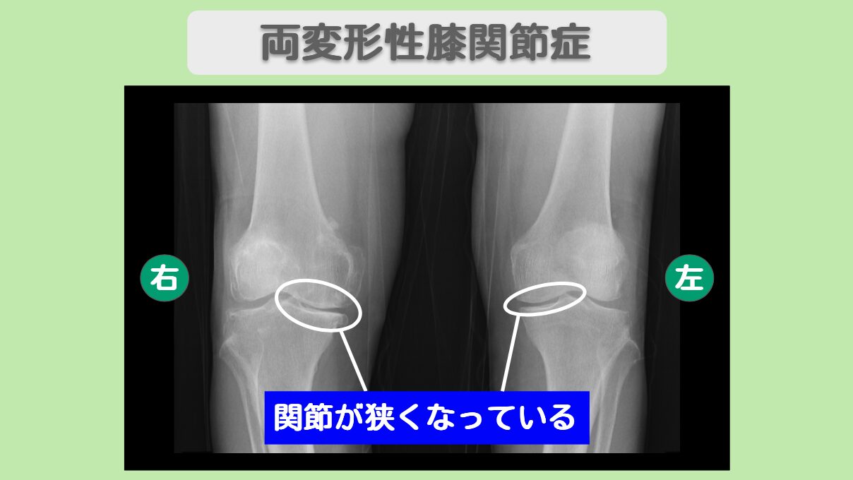 両変形性膝関節症　幹細胞治療