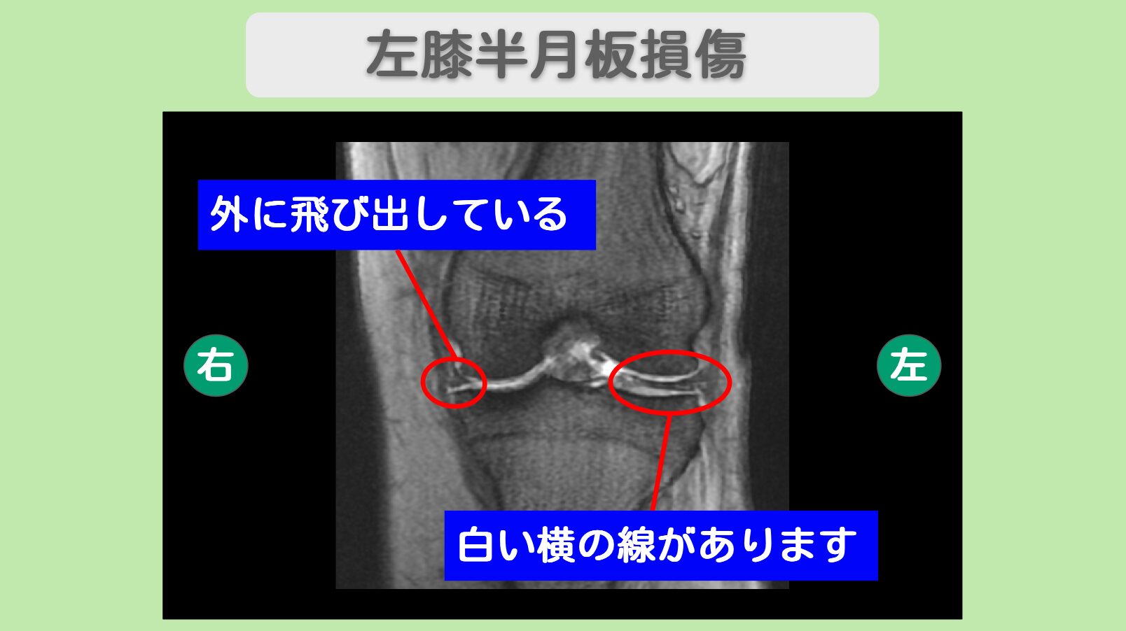 左半月板損傷　幹細胞治療
