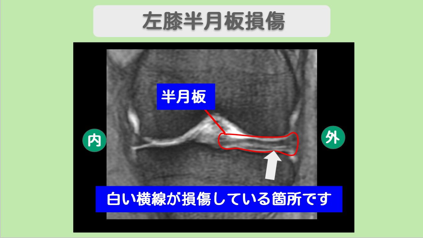 半月板損傷